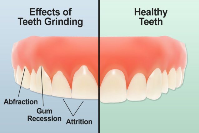 Do You Grind Your Teeth?