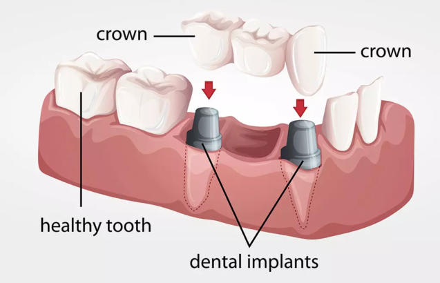 dental-implant-or-dental-bridge-signature-smiles-dental